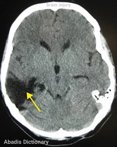 brain injury